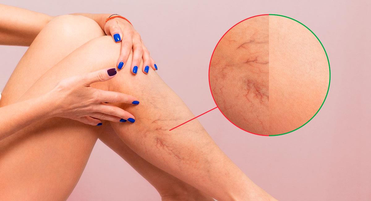 ¿Cuándo hay que preocuparse por las varices en las piernas?. Foto: Shutterstock